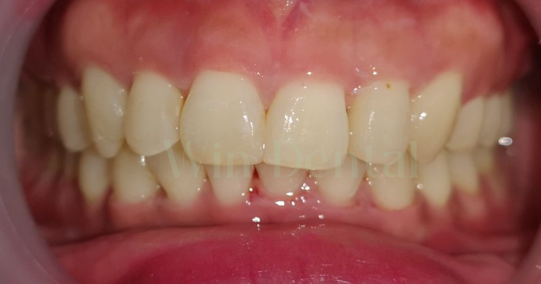 Patient's teeth after braces treatment at Win Dental Clinic