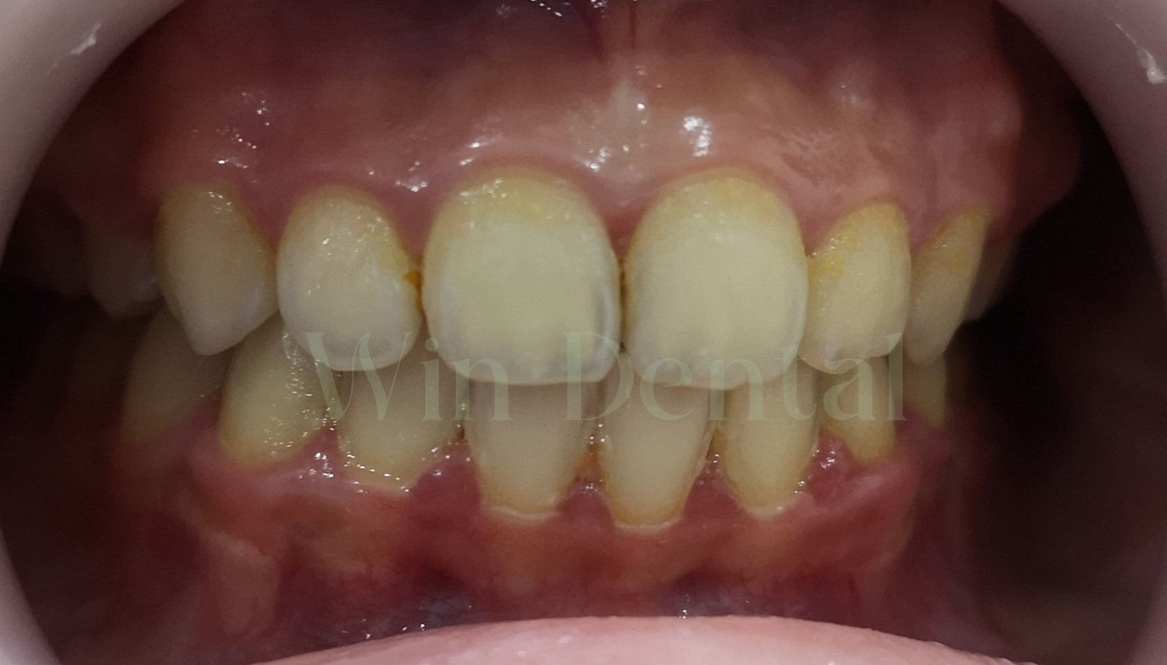 Patient's teeth before professional whitening treatment