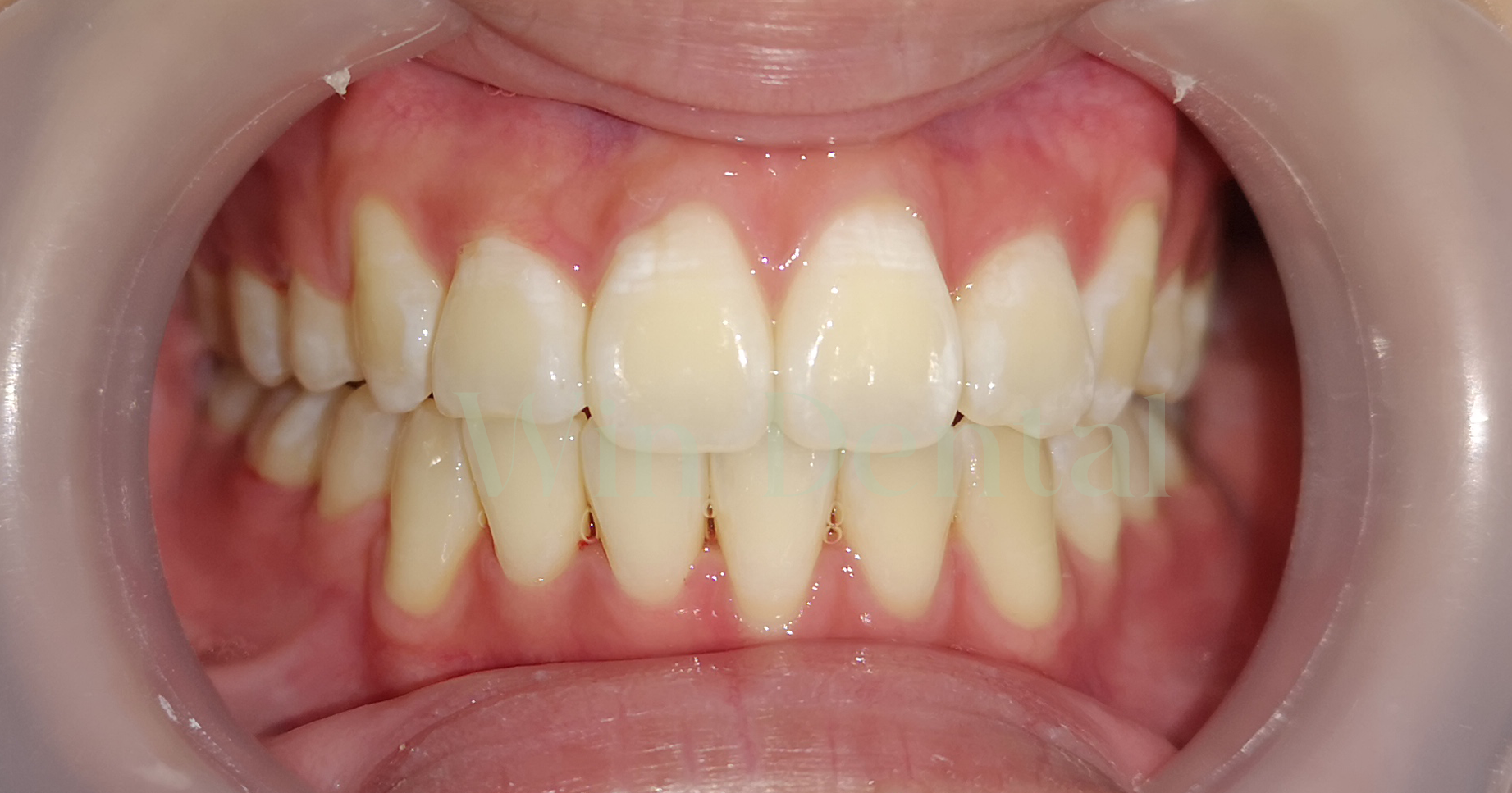 Patient's teeth after braces treatment case2 at Win Dental Clinic